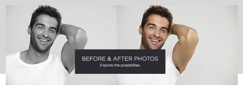 Before After Callout men - Male Breast Reduction