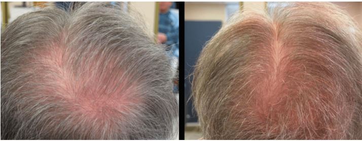 BW PRP - Hair Loss Treatments and PRP: Learn more about this treatment