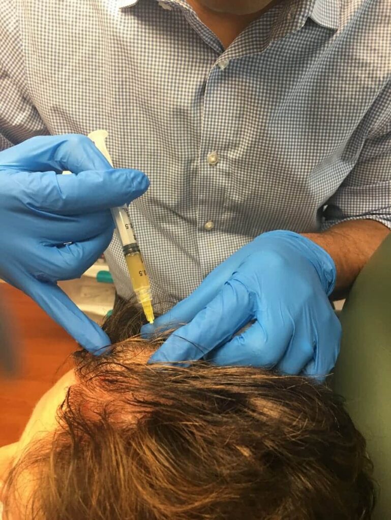 IMG 0464 769x1024 - Hair Loss Treatments and PRP: Learn more about this treatment