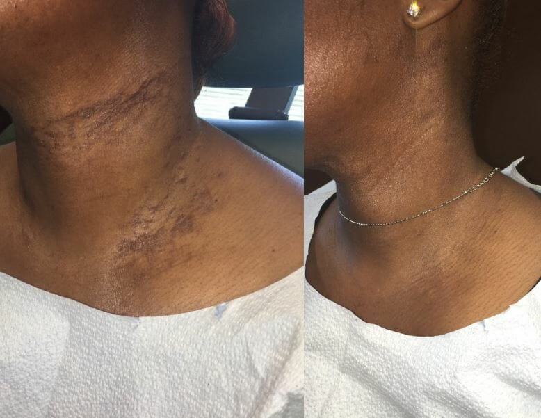 eczema on neck