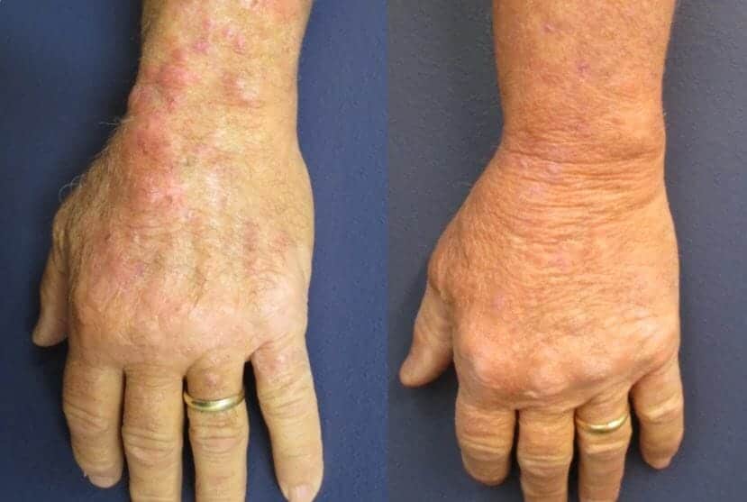 rash fungusba - Skin Infections