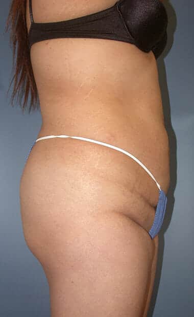brazilian butt lift 1873 - Patient 997