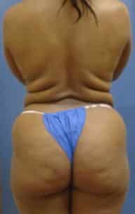 brazilian butt lift 2037 - Patient 4