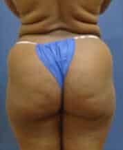 brazilian butt lift liposuction 3642 - Patient 999