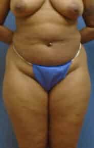 brazilian butt lift liposuction 3643 1 - Patient 11