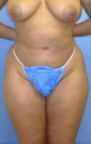 brazilian butt lift liposuction 3644 1 - Patient 11