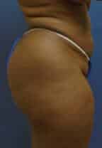 brazilian butt lift liposuction 3645 1 - Patient 11