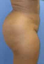 brazilian butt lift liposuction 3646 1 - Patient 11