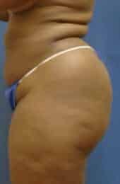 brazilian butt lift liposuction 3647 1 - Patient 11