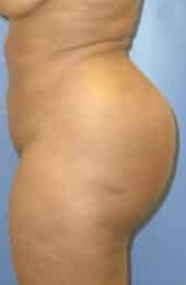 brazilian butt lift liposuction 3648 1 - Patient 11