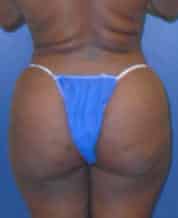 brazilian butt lift liposuction 3649 - Patient 999