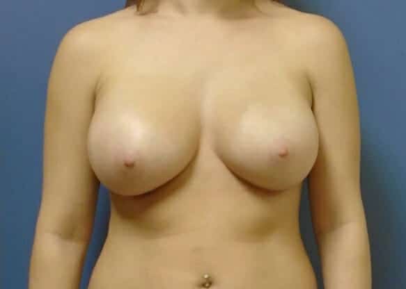 breast augmentation 1264 - Patient 24