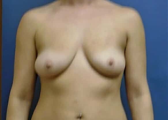 breast augmentation 1265 - Patient 24