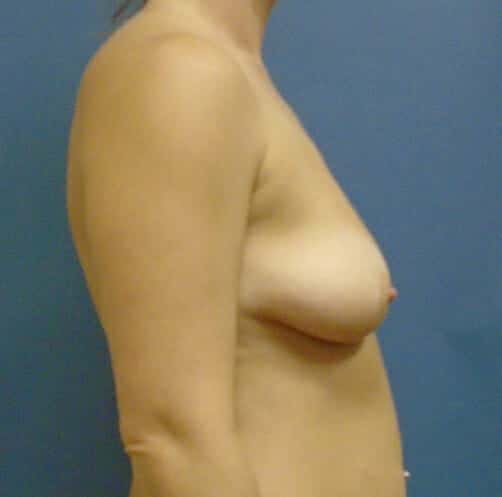 breast augmentation 1266 - Patient 24