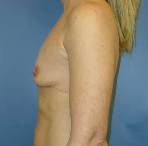 breast augmentation 1308 - Patient 25
