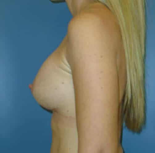breast augmentation 1309 - Patient 25