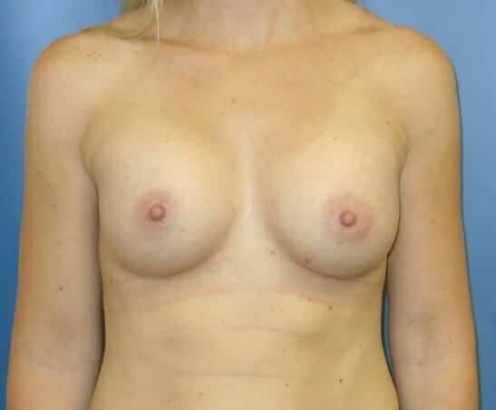 breast augmentation 1310 - Patient 25