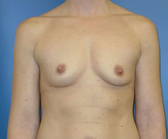 breast augmentation 1311 - Patient 25