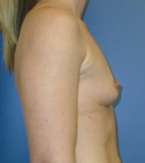 breast augmentation 1312 - Patient 25