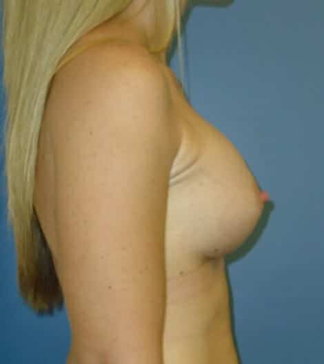 breast augmentation 1313 - Patient 25