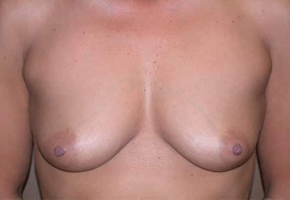 breast augmentation 1364 - Patient 26