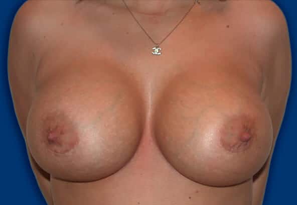 breast augmentation 1365 - Patient 26