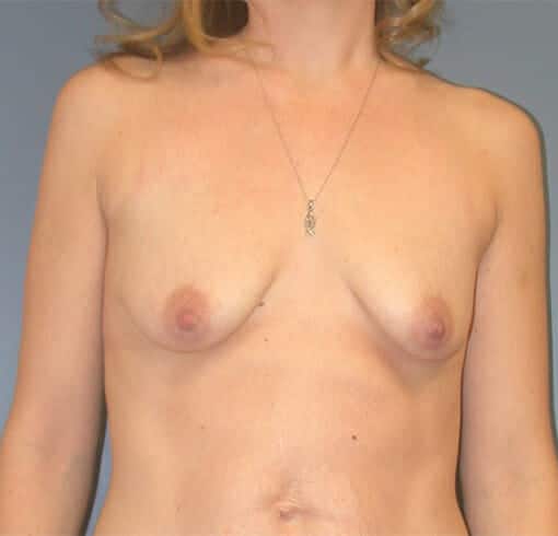 breast augmentation 1572 - Patient 29