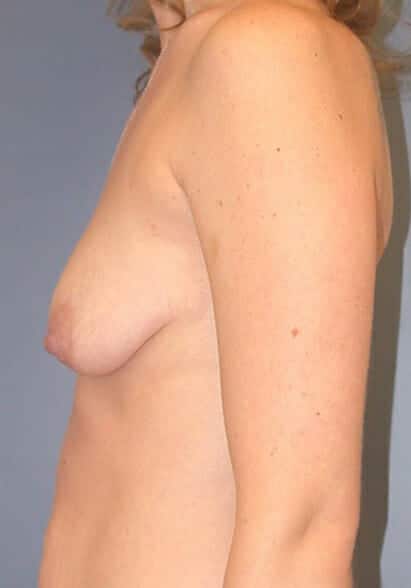 breast augmentation 1573 - Patient 29