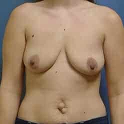 breast augmentation 1608 - Patient 30