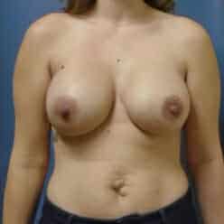 breast augmentation 1609 - Patient 30