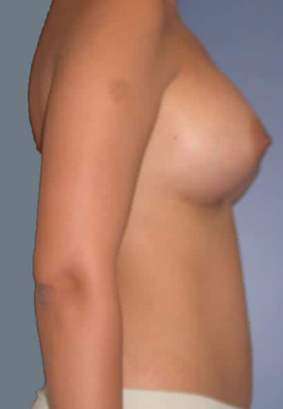 breast augmentation 1713 - Patient 33