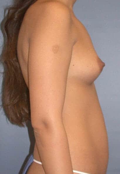 breast augmentation 1714 - Patient 33