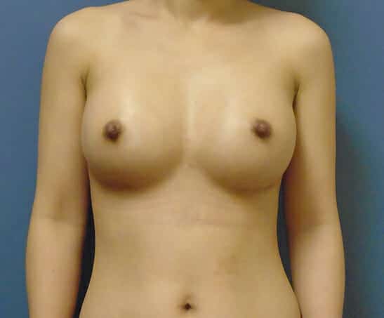 breast augmentation 1746 - Patient 37