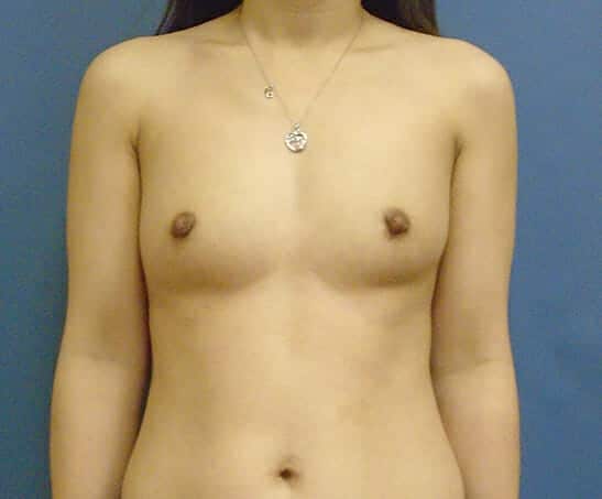 breast augmentation 1747 - Patient 37