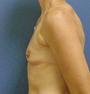 breast augmentation 1777 - Patient 36