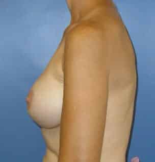 breast augmentation 1778 - Patient 36