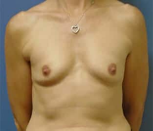 breast augmentation 1779 - Patient 36