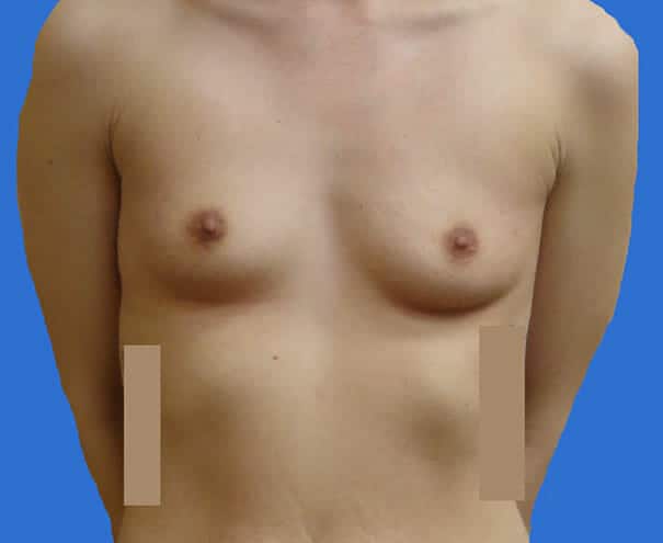 breast augmentation 1914 - Patient 38