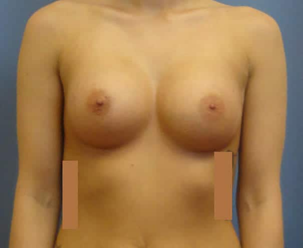 breast augmentation 1915 - Patient 38