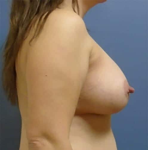 breast augmentation 1947 - Patient 40