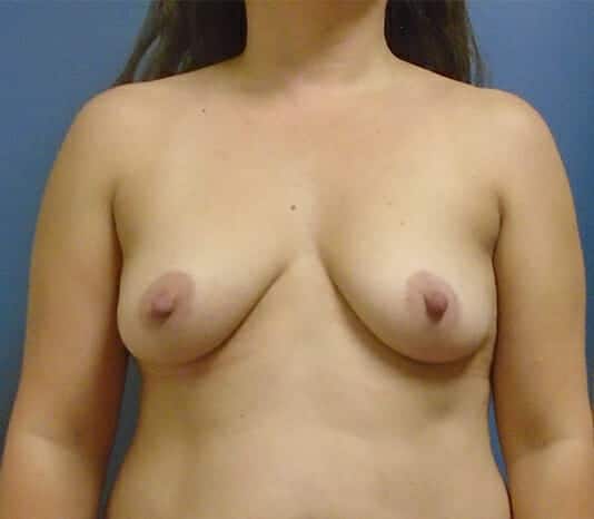 breast augmentation 1948 - Patient 40