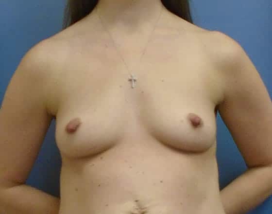 breast augmentation 2046 - Patient 42