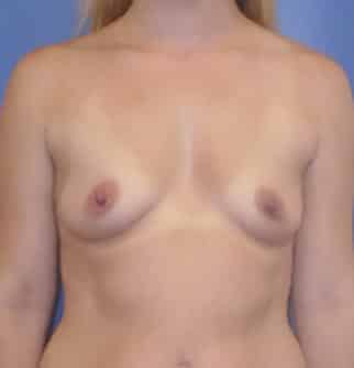 breast augmentation 2194 - Patient 43
