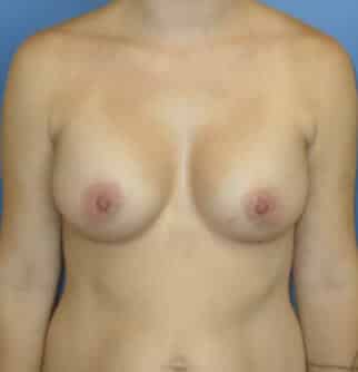 breast augmentation 2195 - Patient 43