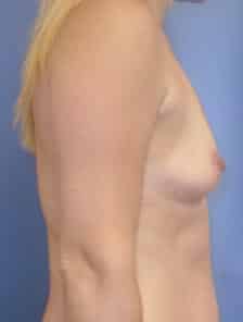 breast augmentation 2197 - Patient 43