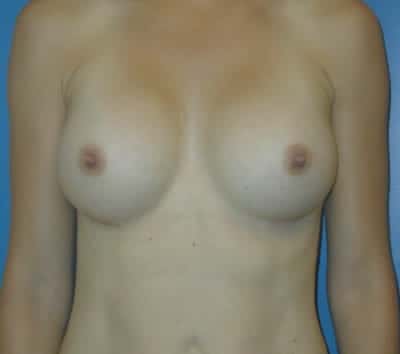 breast augmentation 2515 - Patient 44