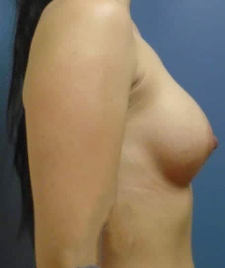 breast augmentation 2948 - Patient 28