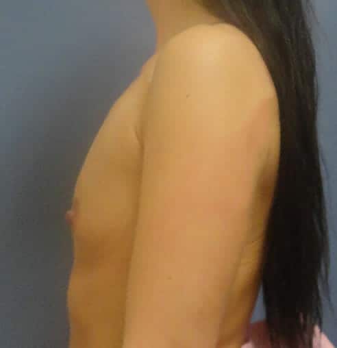 breast augmentation 2950 - Patient 28