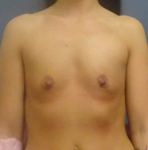 breast augmentation 2952 - Patient 28