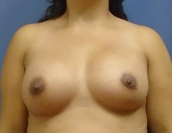 breast augmentation 2954 - Patient 32